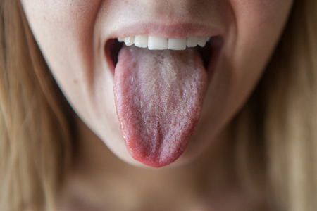 Белый налет на языке - симптомы какой болезни? — Клиника «Доктор рядом»