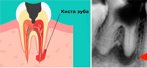 Особенности и преимущества лечения кисты зуба лазером